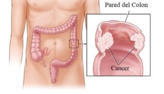 factores-involucrados-en-la-progresion-del-cancer-de-colon-universia-espana